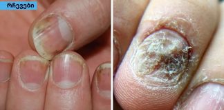 5 ბუნებრივი საშუალება ფრჩხილების ფსორიაზის დროს