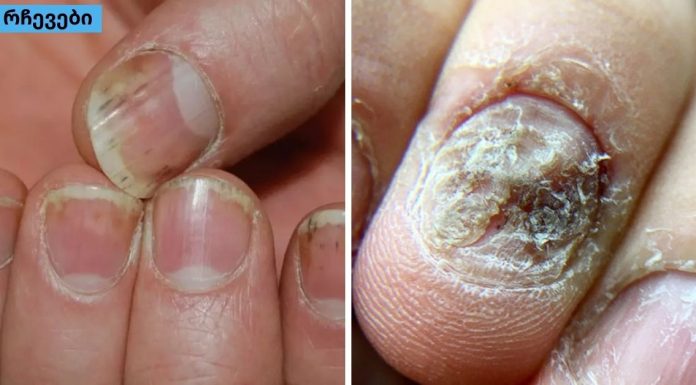 5 ბუნებრივი საშუალება ფრჩხილების ფსორიაზის დროს