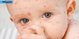 ის, რაც არავითარ შემთხვევაში არ უნდა გააკეთოთ ჩუტყვავილას დროს-სასრაგებლო ინფორმაციაა!