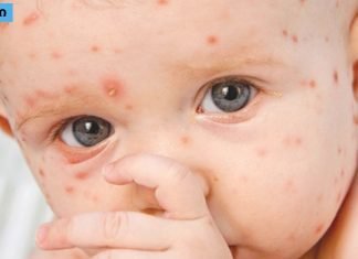 ის, რაც არავითარ შემთხვევაში არ უნდა გააკეთოთ ჩუტყვავილას დროს-სასრაგებლო ინფორმაციაა!