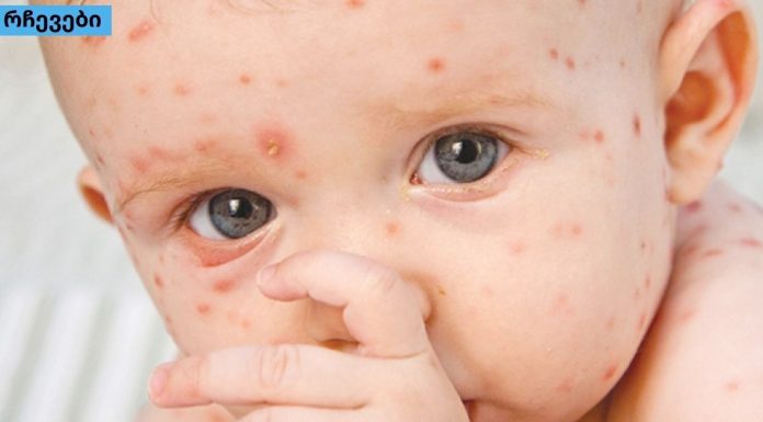 ის, რაც არავითარ შემთხვევაში არ უნდა გააკეთოთ ჩუტყვავილას დროს-სასრაგებლო ინფორმაციაა!