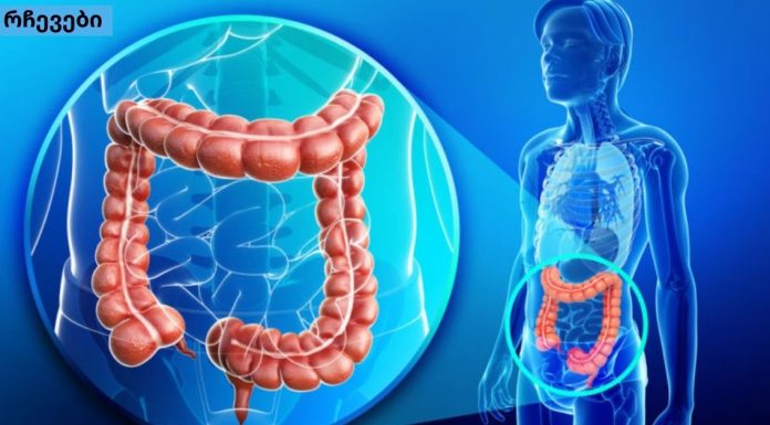 ნაწლავის გაუვალობა – ყველაფერი რაც თქვენ უნდა იცოდეთ ამის შესახებ და საოცარი საშუალებები მის განსაკურნებლად.