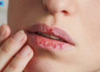 რჩევები,რომლებიც აქამდე არ გსმენიათ დახეთქილი ტუჩების სამკურნალოდ