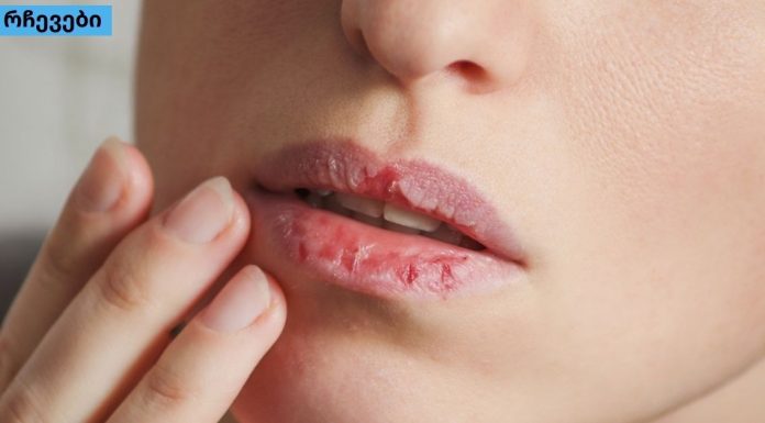 რჩევები,რომლებიც აქამდე არ გსმენიათ დახეთქილი ტუჩების სამკურნალოდ