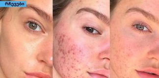 ამ მეთოდებმა ჩემს მეგობარს უშველა,განკურნე აკნე სამუდამოდ .