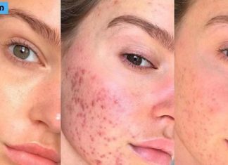 ამ მეთოდებმა ჩემს მეგობარს უშველა,განკურნე აკნე სამუდამოდ .