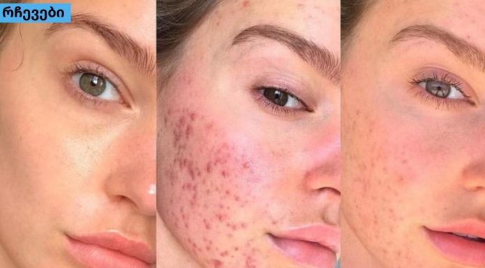 ამ მეთოდებმა ჩემს მეგობარს უშველა,განკურნე აკნე სამუდამოდ .