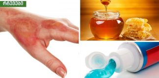 რეცეპტი დამწვრობის ტკივილის შესამსუბუქებლად სახლში