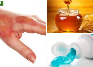 რეცეპტი დამწვრობის ტკივილის შესამსუბუქებლად სახლში