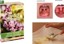 ყელის ტკივილის საუკეთესო ბუნებრივი საშუალებები