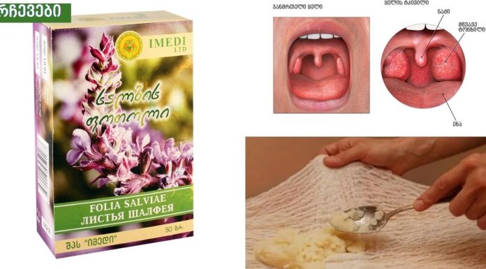 ყელის ტკივილის საუკეთესო ბუნებრივი საშუალებები