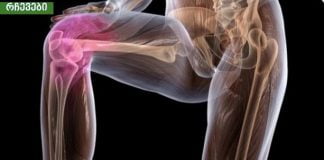 დაემშვიდობეთ ართრიტს და ტკივილს სახსრებში, კისერში, ზურგში მხოლოდ 1 ინგრედიენტით!