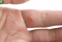 9 ეფექტური საშინაო საშუალება მეჭეჭებისგან თავის დასაღწევად