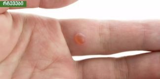 9 ეფექტური საშინაო საშუალება მეჭეჭებისგან თავის დასაღწევად