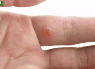 9 ეფექტური საშინაო საშუალება მეჭეჭებისგან თავის დასაღწევად