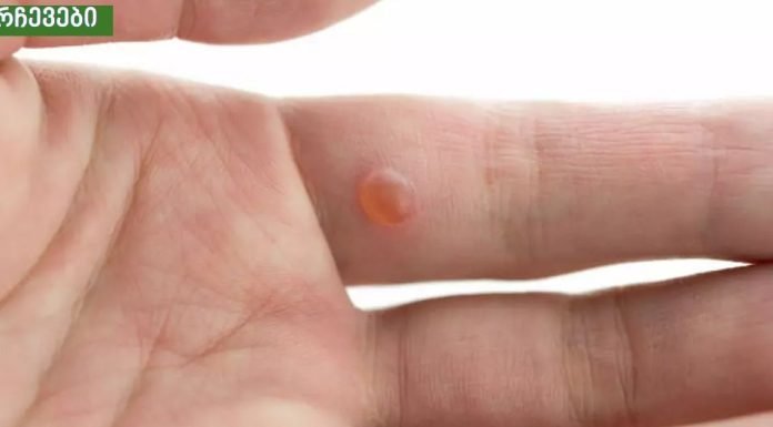 9 ეფექტური საშინაო საშუალება მეჭეჭებისგან თავის დასაღწევად