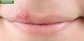 ჰერპესი ტუჩებზე: სახლში მკურნალობა