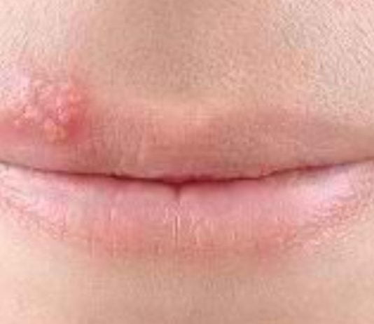 ჰერპესი ტუჩებზე: სახლში მკურნალობა