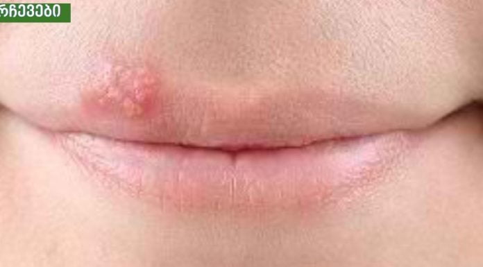 ჰერპესი ტუჩებზე: სახლში მკურნალობა