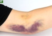 კანზე სილურჯეების გაჩენის მიზეზები. ის, რის შესახებაც ბევრმა არ იცის