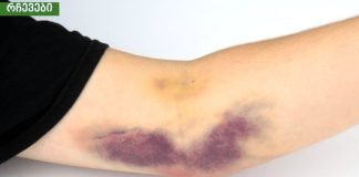 კანზე სილურჯეების გაჩენის მიზეზები. ის, რის შესახებაც ბევრმა არ იცის