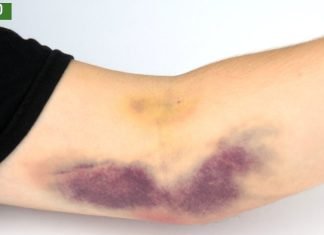 კანზე სილურჯეების გაჩენის მიზეზები. ის, რის შესახებაც ბევრმა არ იცის