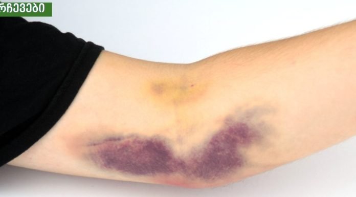 კანზე სილურჯეების გაჩენის მიზეზები. ის, რის შესახებაც ბევრმა არ იცის