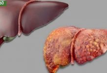 ღვიძლის სიმპტომები რომლებიც არ უნდა დააიგნოროთ,სასიცოცხლოდ მნიშვნელოვანია.