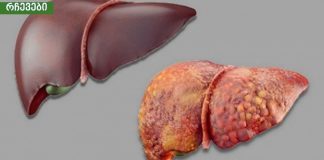 ღვიძლის სიმპტომები რომლებიც არ უნდა დააიგნოროთ,სასიცოცხლოდ მნიშვნელოვანია.