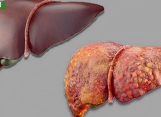 ღვიძლის სიმპტომები რომლებიც არ უნდა დააიგნოროთ,სასიცოცხლოდ მნიშვნელოვანია.