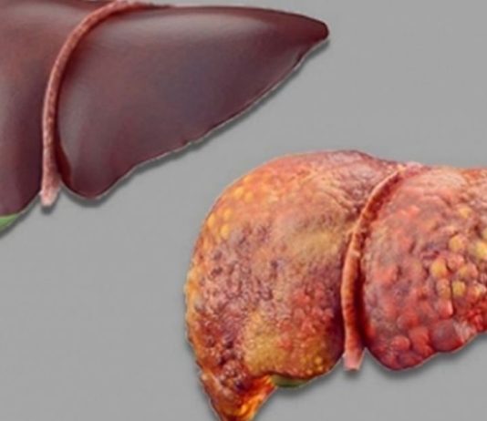 ღვიძლის სიმპტომები რომლებიც არ უნდა დააიგნოროთ,სასიცოცხლოდ მნიშვნელოვანია.