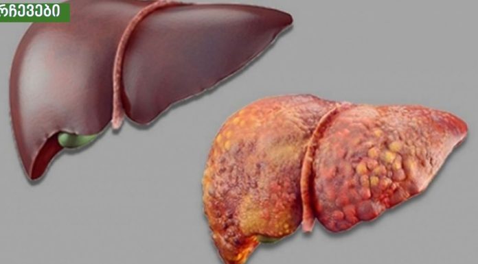 ღვიძლის სიმპტომები რომლებიც არ უნდა დააიგნოროთ,სასიცოცხლოდ მნიშვნელოვანია.