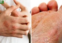 ამ ნარევიდან ხელებსა და ფეხებზე სოკო მყისიერად გაქრება.