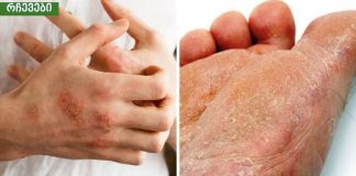 ამ ნარევიდან ხელებსა და ფეხებზე სოკო მყისიერად გაქრება.