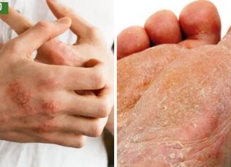 ამ ნარევიდან ხელებსა და ფეხებზე სოკო მყისიერად გაქრება.