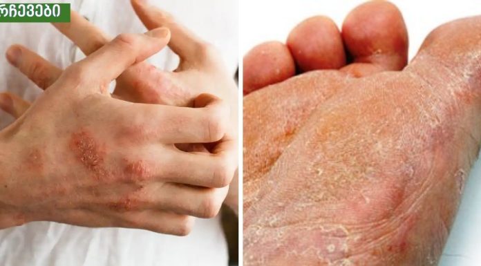 ამ ნარევიდან ხელებსა და ფეხებზე სოკო მყისიერად გაქრება.