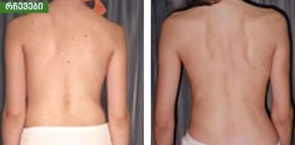 ხერხემლის ჯანმრთელობა თქვენს ხელშია!უმარტივესია.