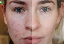 თუ აკნე, ცხიმიანობა და ფერიმჭამელები გაწუხებთ ეს ნიღაბი ყველაზე დიდ შედეგს მოგცემთ