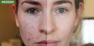 თუ აკნე, ცხიმიანობა და ფერიმჭამელები გაწუხებთ ეს ნიღაბი ყველაზე დიდ შედეგს მოგცემთ