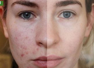 თუ აკნე, ცხიმიანობა და ფერიმჭამელები გაწუხებთ ეს ნიღაბი ყველაზე დიდ შედეგს მოგცემთ