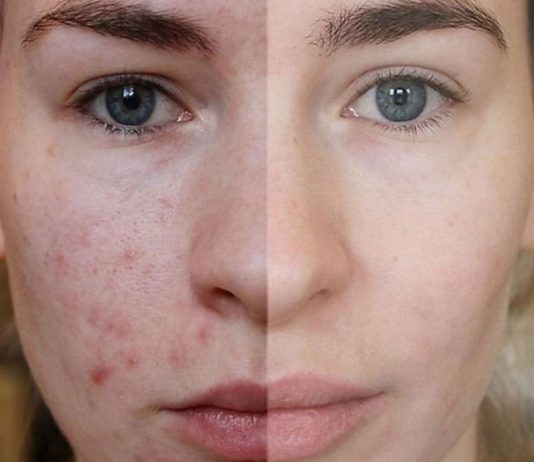 თუ აკნე, ცხიმიანობა და ფერიმჭამელები გაწუხებთ ეს ნიღაბი ყველაზე დიდ შედეგს მოგცემთ