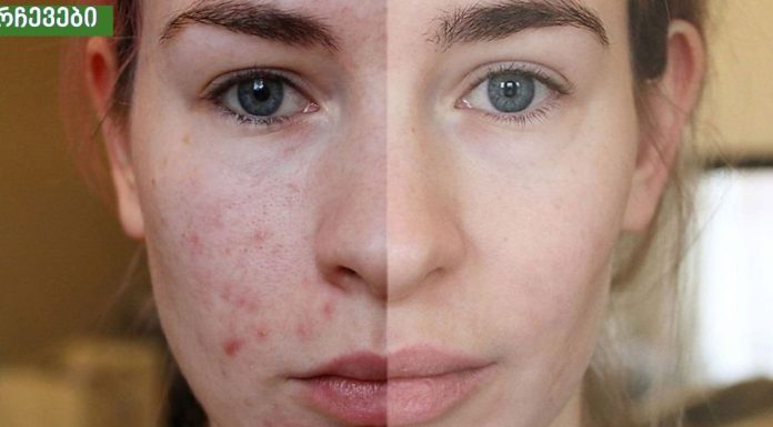 თუ აკნე, ცხიმიანობა და ფერიმჭამელები გაწუხებთ ეს ნიღაბი ყველაზე დიდ შედეგს მოგცემთ