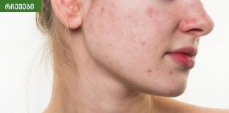 დადასტურებული რჩევები აკნეს სრულად მოსაშორებლად