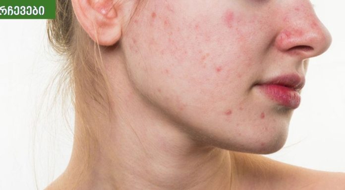 დადასტურებული რჩევები აკნეს სრულად მოსაშორებლად