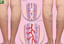 ვარიკოზული ვენების ძირითადი მიზეზი