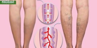 ვარიკოზული ვენების ძირითადი მიზეზი