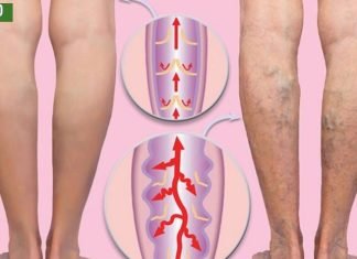 ვარიკოზული ვენების ძირითადი მიზეზი