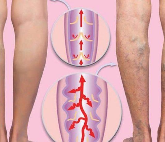 ვარიკოზული ვენების ძირითადი მიზეზი