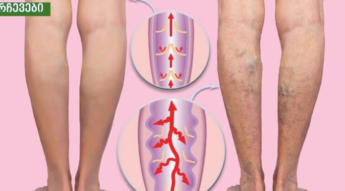 ვარიკოზული ვენების ძირითადი მიზეზი