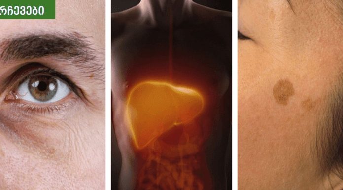 სიმპტომიები, რომელებიც უნდა იცოდეთ ღვიძლის პრობლემებზე